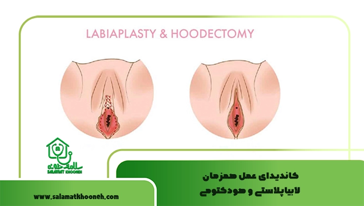 عمل همزمان لابیاپلاستی و هودکتومی