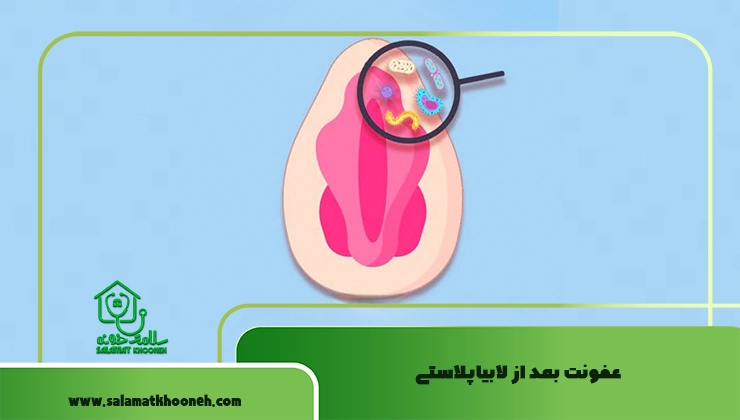 عفونت بعد از لابیاپلاستی