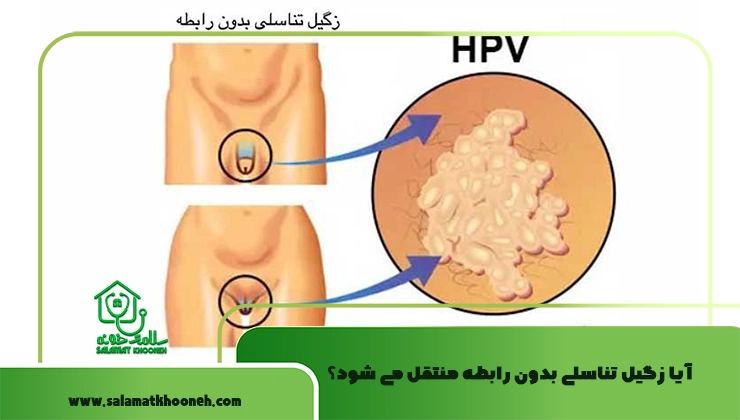 آیا زگیل تناسلی بدون رابطه منتقل می شود؟
