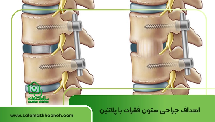 جراحی ستون فقرات با پلاتین