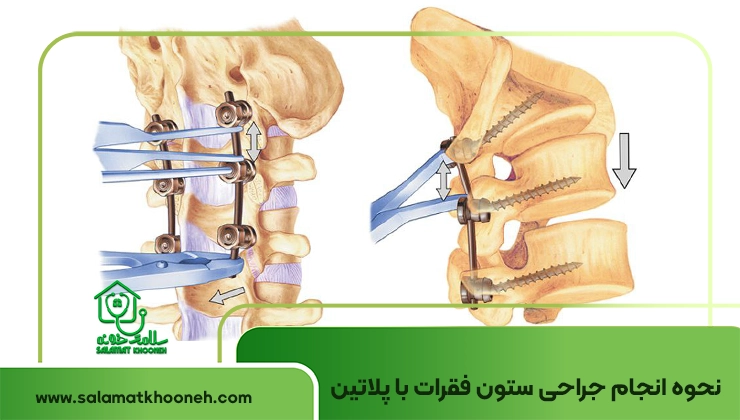 نحوه انجام ستون فقرات با پلاتین