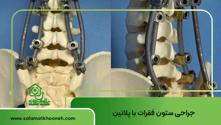 جراحی ستون فقرات با پلاتین