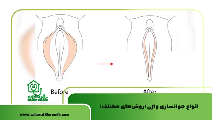جوانسازی واژن با لابیاپلاستی