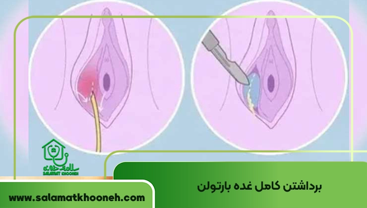 برداشتن غده بارتولن