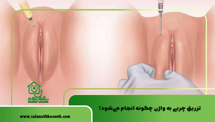 تزریق چربی به واژن چگونه انجام می‌شود؟