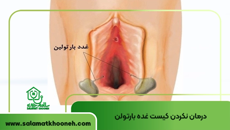 درمان نکردن کیست غده بارتولن