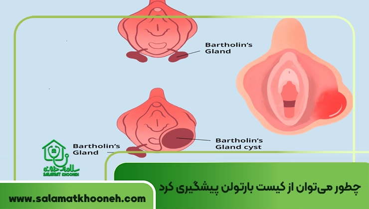 پیشگیری از کیست بارتولن