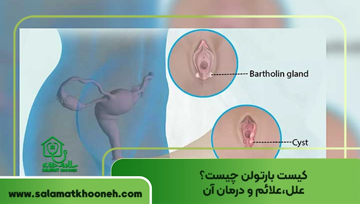 کیست بارتولن