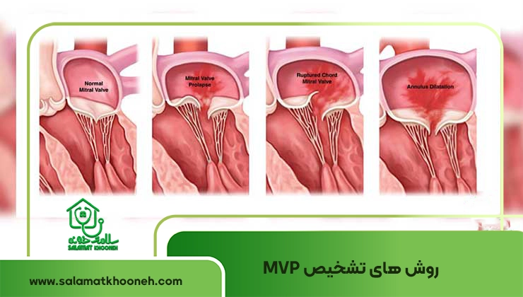 تشخیص افتادگی دریچه میترال