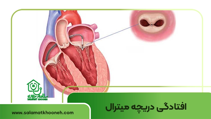 افتادگی دریچه میترال