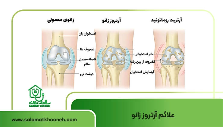 علائم آرتروز زانو