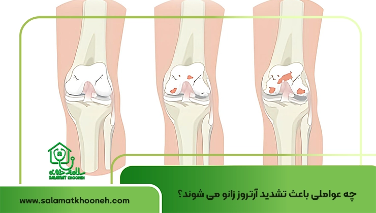knee arthrosis