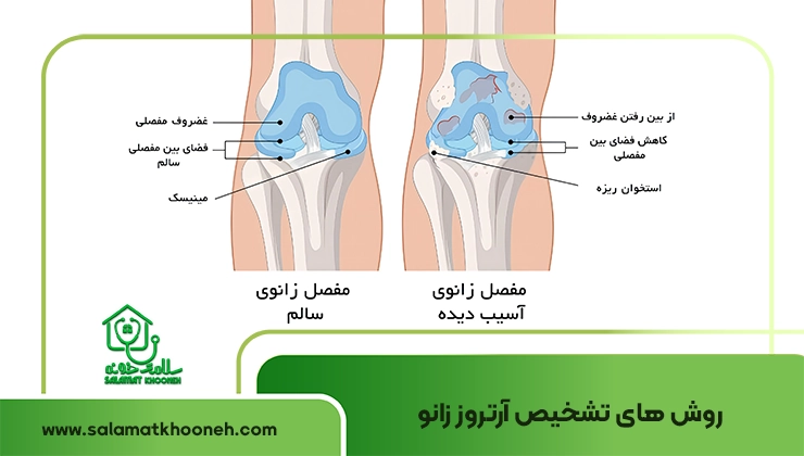 تشخیص ارتروز زانو
