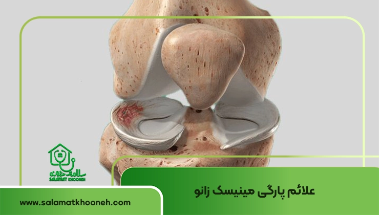علائم پارگی مینیسک زانو