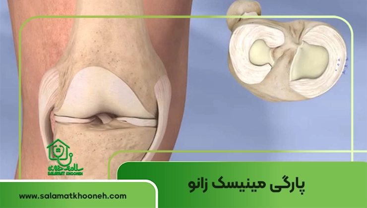 Knee meniscus tear