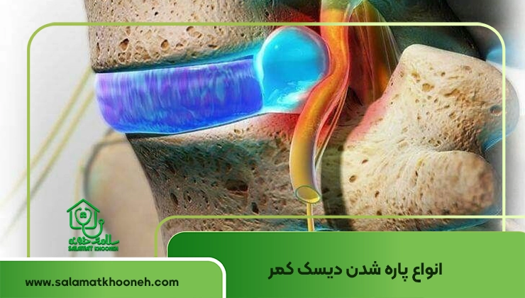 پاره شدن دیسک کمر