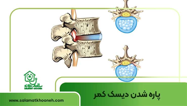 پاره شدن دیسک کمر