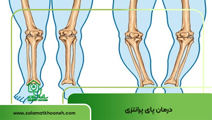 درمان پای پرانتز