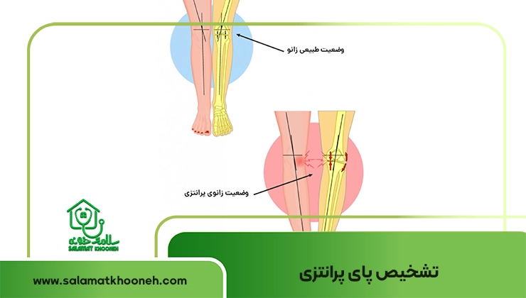 تشخیص پای پرانتز