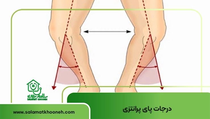 bracket leg