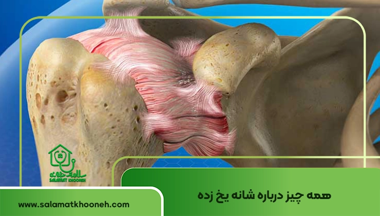 شانه یخ زده