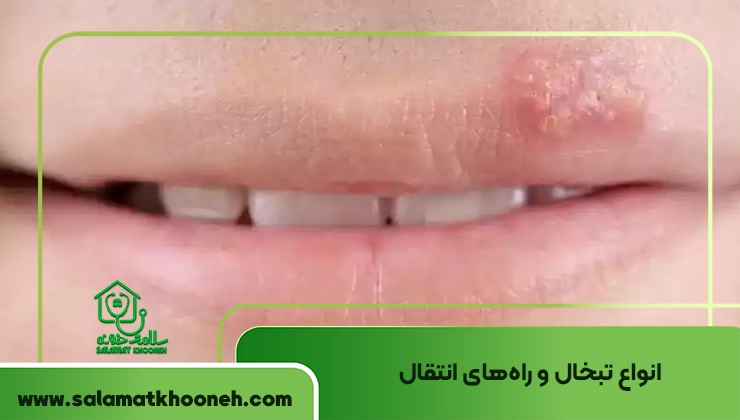 انواع تبخال و راه‌های انتقال