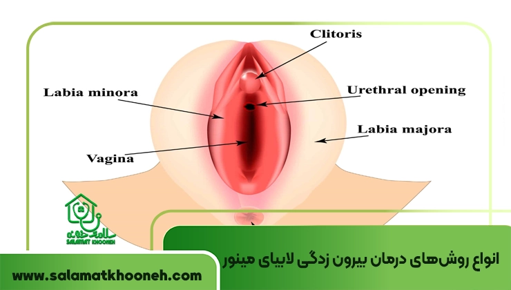 درمان بیرون زدگی لابیای مینور