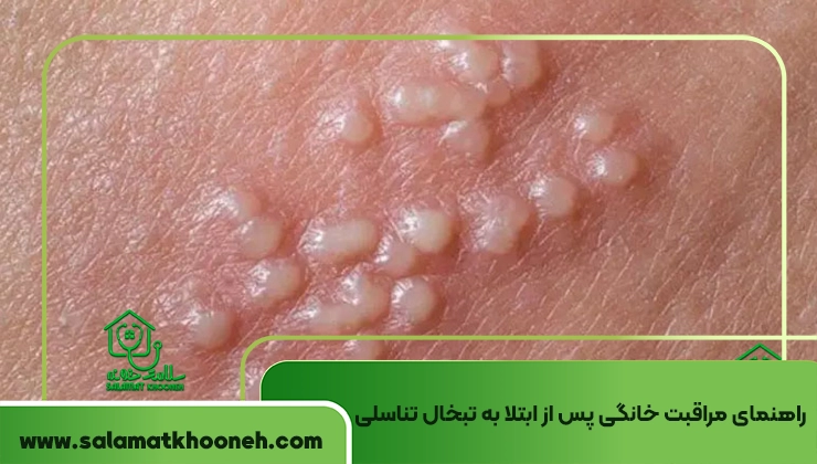 جلوگیری از عود تبخال تناسلی 