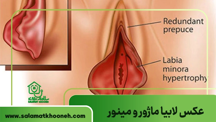 عکس لابیا ماژور و مینور