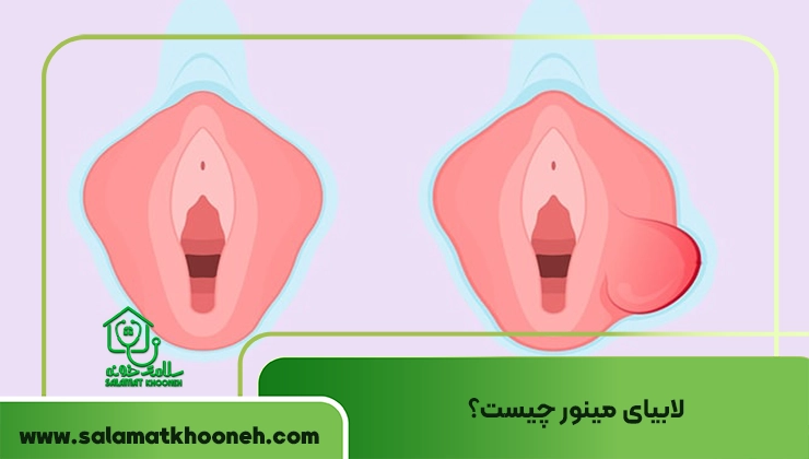 لابیای مینور