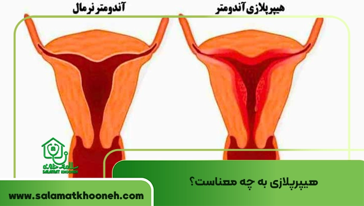 انواع هیپرپلازی
