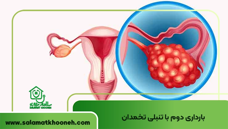 بارداری دوم و تنبلی تخمدان