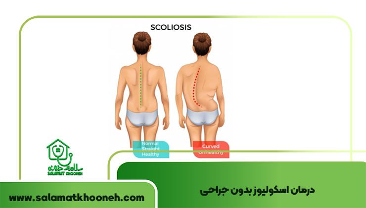 درمان اسکولیوز بدون جراحی