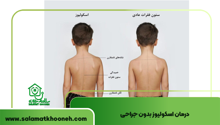 نحوه درمان اسکولیوز شدید بدون جراحی