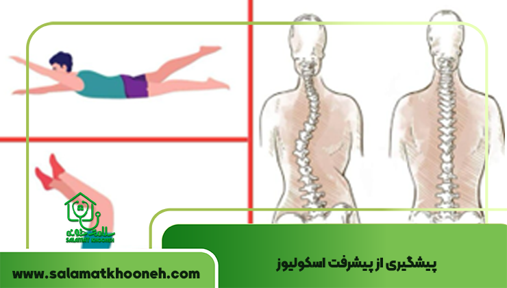 پیشگیری از پیشرفت اسکولیوز