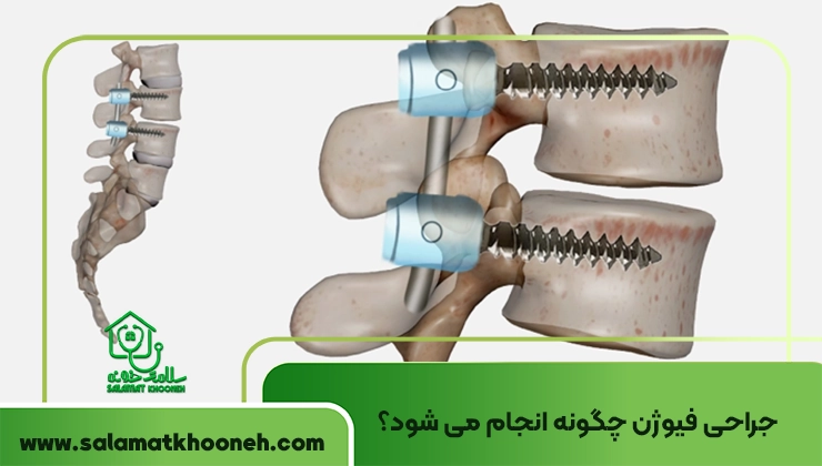 Spinal Fusion
