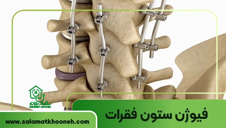 فیوژن ستون فقرات