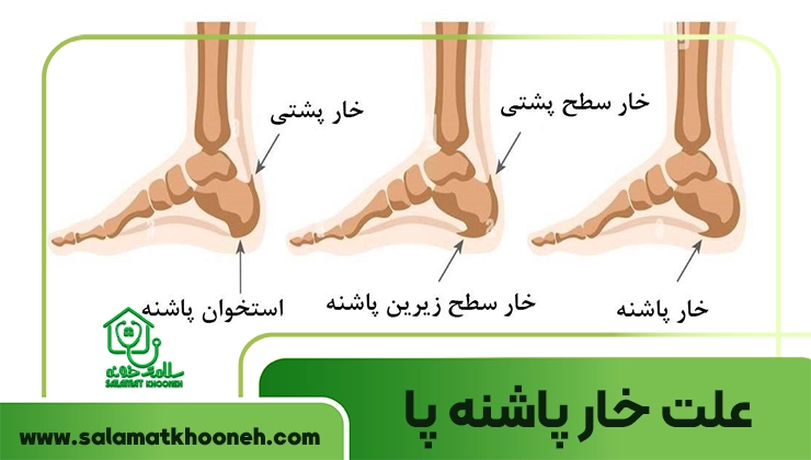 علت خار پاشنه