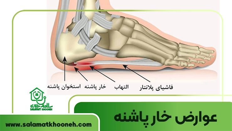 heel spur