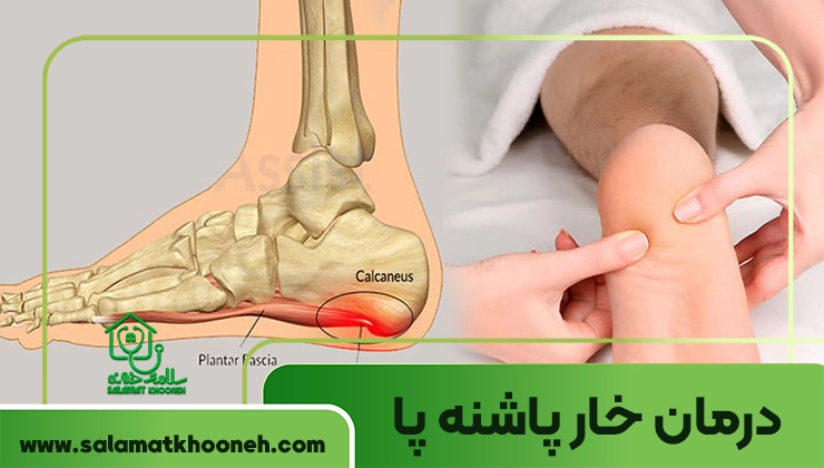 درمان خار پاشنه