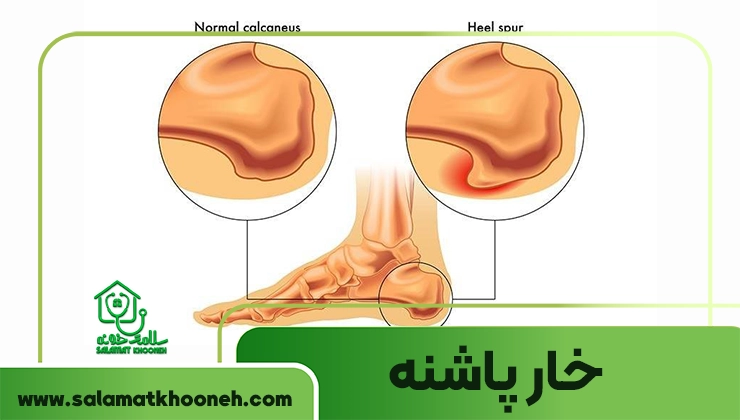 خار پاشنه