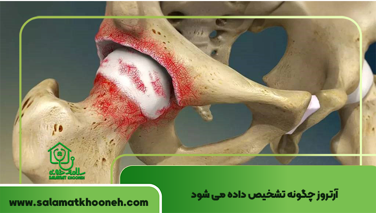 آرتروز چگونه تشخیص داده می شود