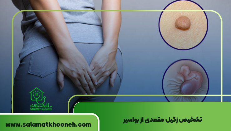 تشخیص زگیل مقعدی از بواسیر