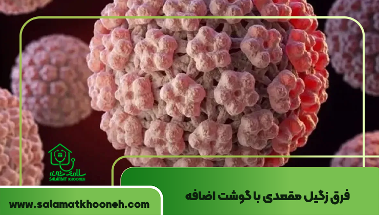 فرق زگیل مقعدی با گوشت اضافه