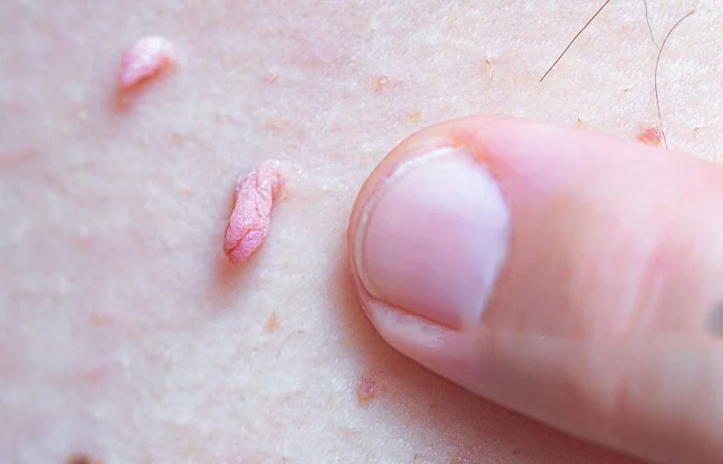 بهترین دکتر لیزر زگیل تناسلی HPV