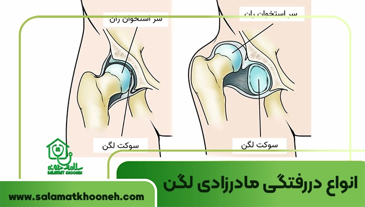 انواع دررفتگی مادرزادی لگن