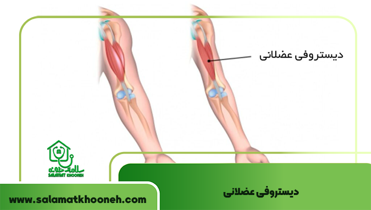 دیستروفی عضلانی