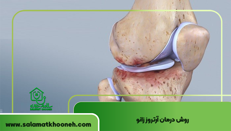 روش درمان آرتروز زانو
