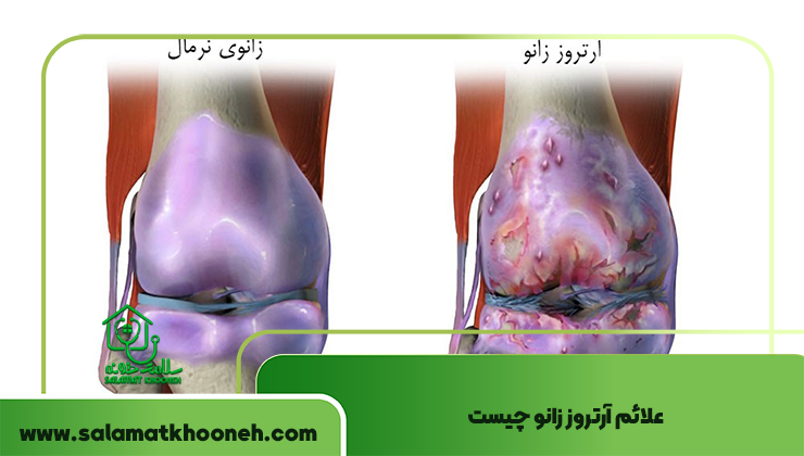 علائم آرتروز زانو چیست