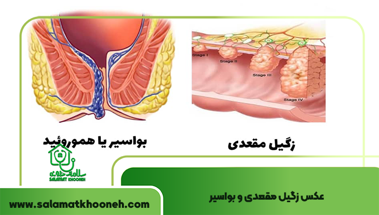 عکس زگیل مقعدی و بواسیر